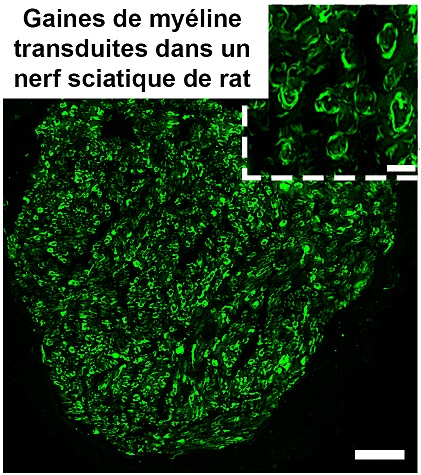 La thérapie génique, un espoir contre les maladies de Charcot-Marie-Tooth